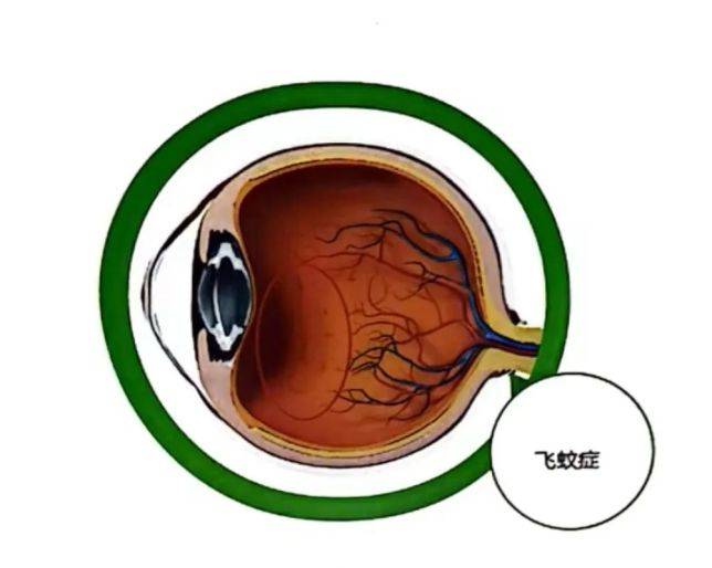 飛蚊癥治療最新突破，開(kāi)啟視界新篇章